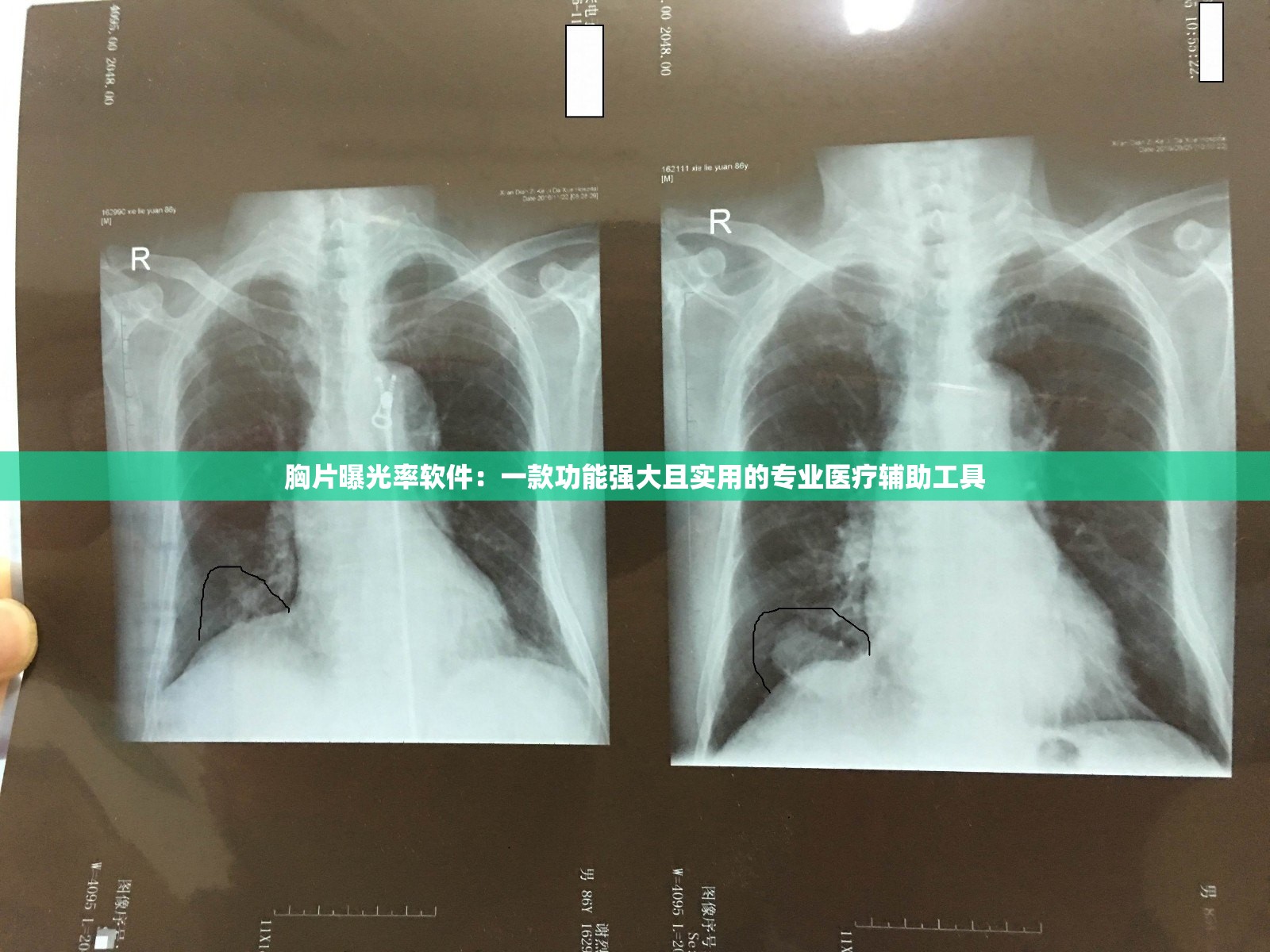 胸片曝光率软件：一款功能强大且实用的专业医疗辅助工具